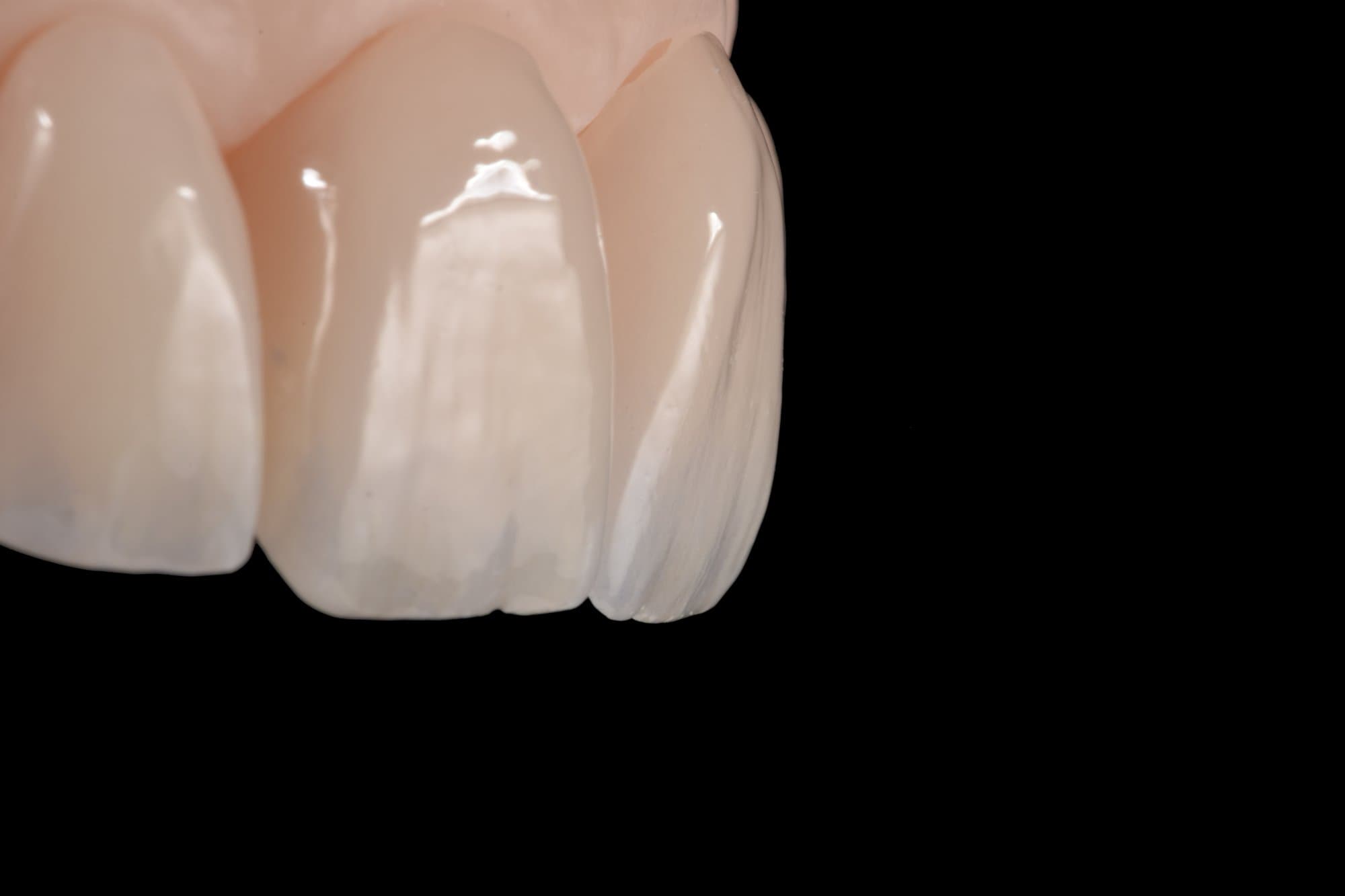 Carillas de porcelana realizadas en Casal Laboratorio Dental, Buenos Aires